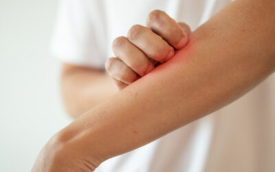 Is This Heat Rash or Poison Ivy? Common Summer Skin Rashes in Allen, TX